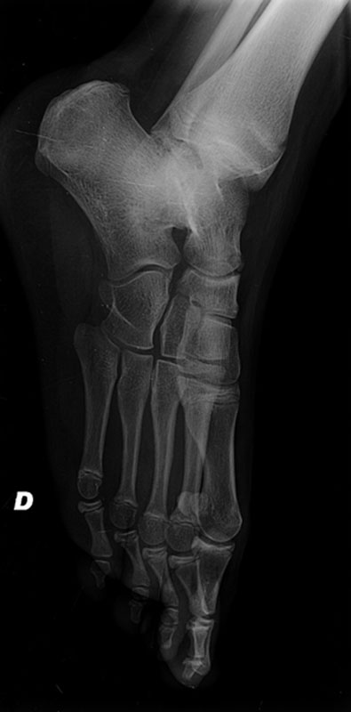 Imagerie_pathologie_arriere_pied - Réponse Cas 12